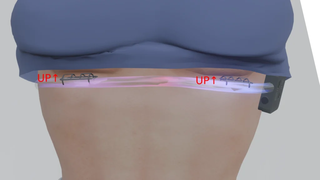 Breast Breeze Air connectors facing Up